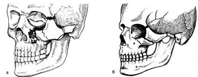 Перелом скуловой кости фото